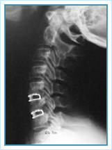 Columna Cervical - 2